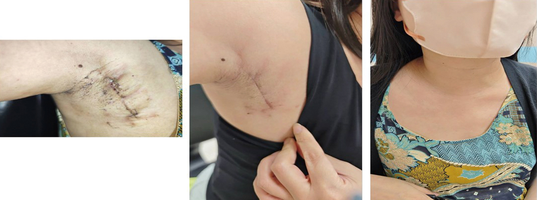 精準甲狀腺手術